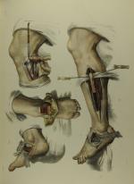 BOURGERY, BERNARD, JACOB. Anatomie de l'homme.Guérin, 1866. 3 volumes grand...